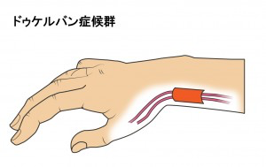 腱が厚くなって、鞘（さや）に収まらいと痛む