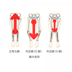 O脚だと腰が下がり背骨を圧迫する。（X脚も同じ）