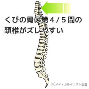 首の骨は第４/５間の頚椎がズレやすい