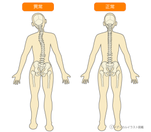 骨盤の歪み