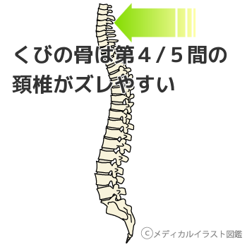 首の骨は第４/５間の頚椎がずれやすい