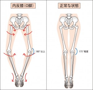 O脚と正常な膝